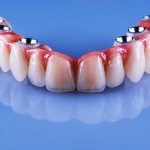 Implant Dentar – Intrebari si raspunsuri – Preturi Implanturi
