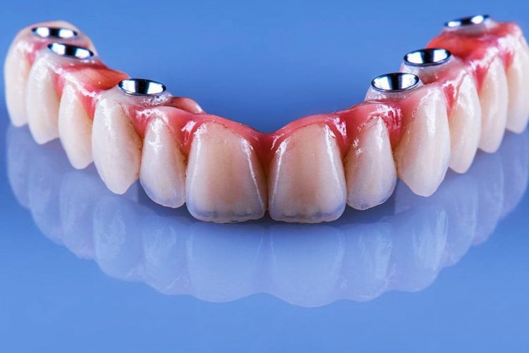 Implant Dentar – Intrebari si raspunsuri – Preturi Implanturi