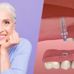 Tot ce trebuie sa stii despre implantul dentar
