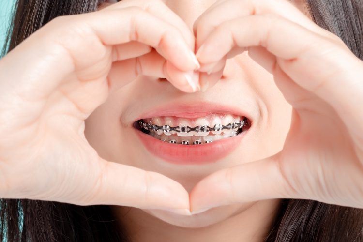 5 semne care arata ca ai nevoie de un aparat dentar