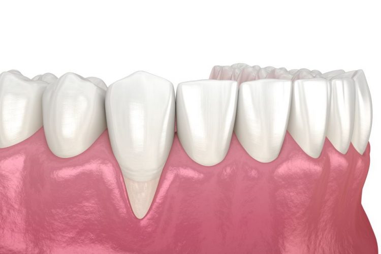 De ce apare retractia gingivala si cum se poate trata?