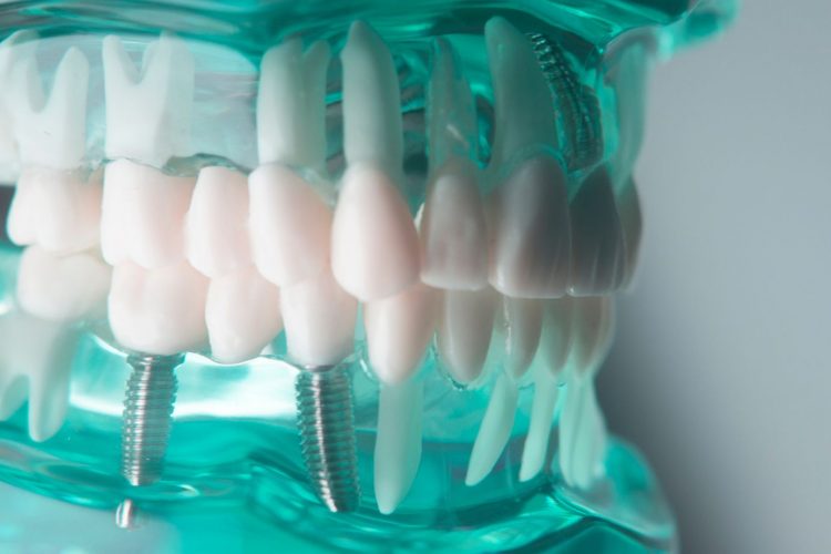 Top 5 mituri despre implantul dentar